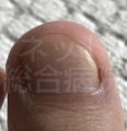ラミシールクリーム-爪水虫が改善